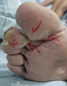 Common foot warts before professional removal treatment